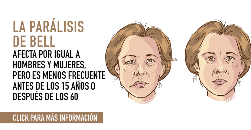 Parálisis de Bell